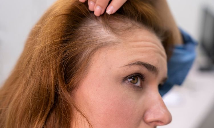 El impacto psicológico de la alopecia y cómo combatirlo